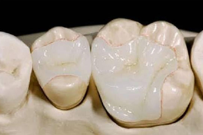 Inlay dental malaysia Dento