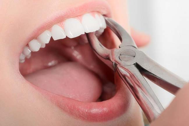 tooth-extraction-removal-icons tooth-extraction-removal-icons